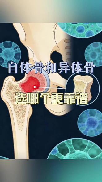自体骨和异体骨选哪个更靠谱? 自体骨和异体骨选哪个更靠谱?#抖出健康知识宝藏#医疗健康创作训练 #women的健康我们帮 #妇科问题我来帮#自体骨@郭家全主任骨科团队