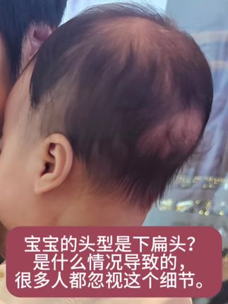 下扁头其实是枕骨上移,后脑勺下方扁平或者凹陷的一种头型问题,且头顶高尖。这种头型一般和长期横抱有关系,特别是那些只能抱睡才能睡的宝宝。这样的头型是比较难纠正的哦,但可以通过左右侧睡,头顶用枕头抵挡来进行改善。#宝宝下扁头 #宝宝枕骨上移 #育婴知识 #抱睡宝宝 #宝宝定型枕