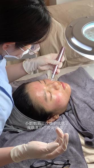 福州|院线填痘坑操作流程 #热门 #福州打卡 #福州皮肤管理 #福州仓山万达 #福州