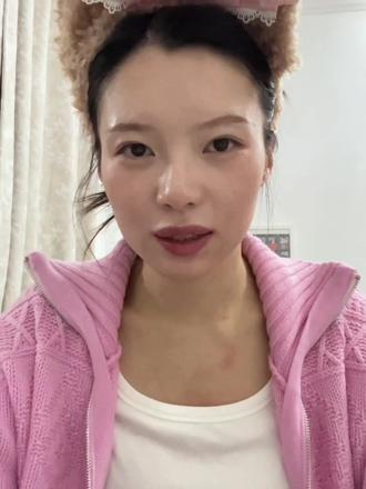 volg6️⃣嘎眼袋恢复全程记录📝
#vlog十亿流量扶持计划 #生活碎片 #眼袋手术 #眼袋