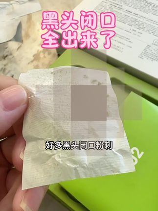 无美颜无滤,真实自用,黑头闭口粉刺都出来了,好干净呀….#闭口粉刺 #黑头 #黑头三件套