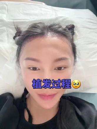 #植发手术 #发际线植发 植发过程、面部全非呀🤣