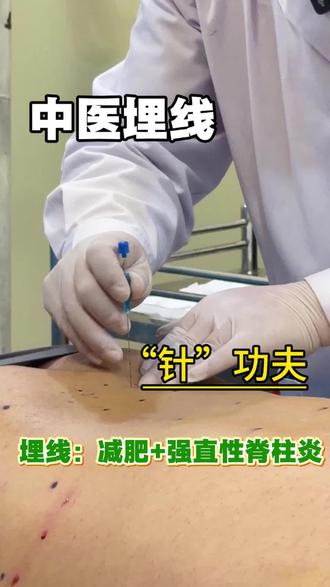 埋线:减肥+强直性脊柱炎 #中医针灸#中医埋线#埋线减肥 #医生日常#洛阳孙大夫