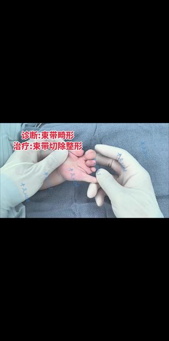 羊膜束带畸形整形 诊断:束带畸形。治疗:束带切除整形。#束带 #束带综合征 #羊膜束带综合征 #张立山手足畸形矫形