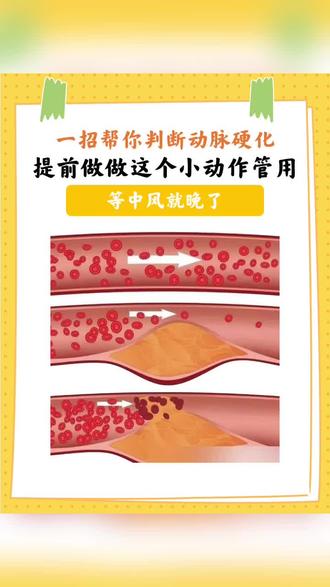 想知道自己血管硬没硬?教你一个超简单的 “摸脉搏” 方法,在家就能测,赶紧学起来~
✨ 关键动作:摸手腕 + 脚背脉搏
先摸手腕内侧的桡动脉(中医号脉的位置),感受脉搏跳动是否规律、有力;再摸脚背最高点的足背动脉,对比两处脉搏的跳动力度和频率。
如果两处脉搏都清晰、有力,跳动节奏一致,说明血管弹性还不错
若足背动脉搏动明显变弱,甚至摸不到,或者和手腕脉搏差异很大,要警惕下肢动脉硬化(《中华老年医学杂志》曾提到,足背动脉搏动减弱是下肢动脉硬化的重要信号之一)
❓ 为啥这个方法管用?
动脉硬化会让血管管腔变窄、弹性下降,离心脏越远的血管(比如足背动脉),越容易先出现供血不足,表现为脉搏变弱。这个方法能快速初步判断外周血管状态,尤其适合中老年人和久坐、高油饮食的人群。
测出异常怎么办?
别慌!这只是初步判断,不是确诊。若足背动脉搏动异常,建议及时做这两项检查:
下肢血管超声:看血管是否有斑块、狭窄
血压检查:动脉硬化常伴随血压升高或脉压差增大(高压减低压大于 60mmHg)
日常护血管小提醒
每天踮脚 100 次,能促进下肢血液循环;每周吃 2-3 次深海鱼(如三文鱼、沙丁鱼),其中的 Omega-3 有助于保持血管弹性(《中国居民膳食指南》推荐)。
血管软,身体才灵活,别让动脉硬化悄悄找上门~ 这个方法赶紧分享给家人,一起自查@DOU+小助手 @抖音小助手 @人民网