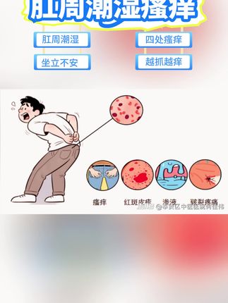 #肛周湿疹 #肛周脓肿 #肛周瘙痒 #肛周潮湿 #痔疮 肛周潮湿瘙痒的痛,让北京同仁堂医用痔疮凝胶来帮你解决,医用级别药检备案双重认证让你用着安心,告别潮湿瘙痒!