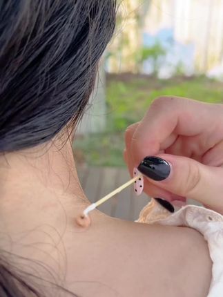 #脖子上的小肉粒 #变美就是这么简单 #祛疣不留印