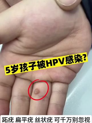 #疣#扁平疣 #跖疣 #Hpv 千万别用烟头去烫疣了!