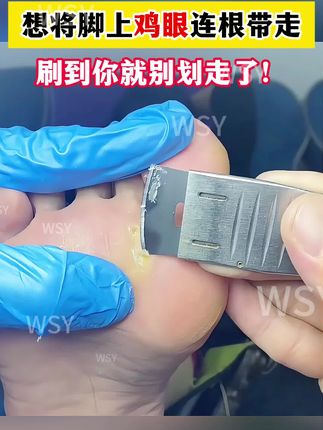 一个方法教你将鸡眼连根带走,千万别错过#鸡眼 #鸡眼去除小妙招 #鸡眼怎么能彻底根治 #鸡眼怎么去除 #鸡眼怎么办