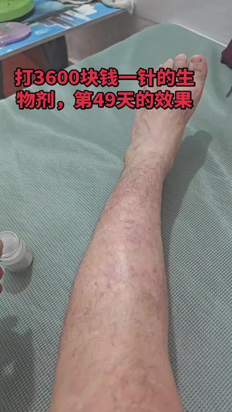 3600块钱一针,报销过后,1200块钱,你们严重的都不用考虑了,打针吧,打针不痒,生活有盼头