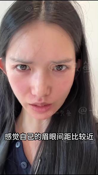 额头提升1⃣️周恢复记录,🧑⚕️夸我恢复的不错#额头提升 #眉压眼 #提眉 #上海李晓霞 #变美