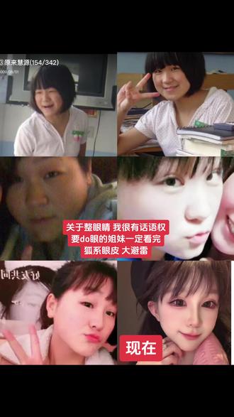 双眼皮 狐系双眼皮 捏脸 整容 #干货分享 #双眼皮手术 #整形 #避雷