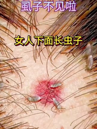 仁和药业百部酊喷雾剂男女阴用成人祛除虱子虱卵虱立净一扫光正品#长虱子怎么消除 #消除虱子卵的小妙招 #身上长虱子怎么消除 #草本植物 #百部酊喷剂