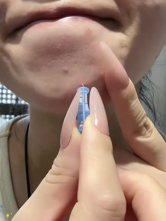 这个一次性的,可比大头针好用太多了!关键还便宜!老爱手欠挤包包的,就用这种比头发丝还细的次抛,干净卫生还方便 #女生必备 #痘痘肌 #清洁工具 #我捡到宝了#种草