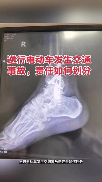 逆行电动车发生交通事故责任会如何划分? 逆行电动车发生交通事故责任会如何划分?
两个电动车在道路上相撞了,其中一方电动车是逆向行驶,在碰撞前几秒的时候逆行电动车停住了,但是正常行驶的车辆没有停住,两车发生了接触。逆向行驶的电动车驾驶员咨询:他车辆已经停住了,被对方撞了,责任会不会是对方的全部责任?
答案是不可能的。虽然车辆停住了,两车发生了接触,但这起交通事故最主要的原因是逆向行驶,交警会判定逆行方责任更大一些。
如果您有关于交通事故方面的问题,欢迎与我沟通交流。#交通事故赔偿 #交通事故处理 #车祸赔偿 #伤残鉴定 #交通事故理赔