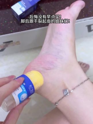 嫩脚养成了#脚后跟粗糙怎么变嫩 姐妹冲~