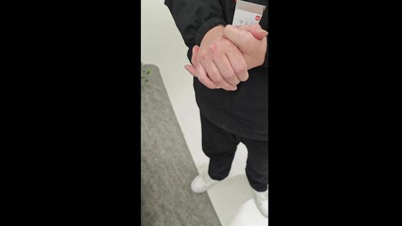 小米17promax首发遭遇质量问题,不提供只换不修越修越坏 小米17promax在游戏过程由于粘胶固定不牢导致形变脱落。小米官方以外观损坏不属于硬件问题为由拒绝只换不修,甚至在进行了相应的检测后确认镜头非人为脱落(都是在小米售后都有相应的流程)同意了免费维修更换,但是他们处于保险起见(说法是不能保证绝对不存在人为损坏的情况)在售后单以及这次沟通过程中都模糊镜头脱落具体原因以及进行声明,本身作为相关消费者也表示理解,但是没想到随后维修导致越修越坏,甚至新换后盖也被翘坏然后在后摄有个别灰尘颗粒并且第二天发现新换后盖背屏出现持续防误触模式生效导致无法正常使用(经过排查初步确定传感器故障,但是售后表示还需要拆机确定情况)并且表示维修产生的瑕疵属于正常情况,如果确实是安装问题就继续使用后盖,非安装问题再考虑换没有问题的新后盖,最终经过拆机检查确定是新换后盖传感器有故障并且维修功能检测流程存在问题才导致我最终拿到了故障机。总之这一波售后拉扯下来我承担了很多不属于我的责任,最终决定将其中最后一段视频录制下来作为存档,希望有遇到类似问题的朋友能够留一个心眼,保护好自己的设备,避免在高温以及散热不良的情况使用,同时小米对于只换不修政策的也进行了更新,我个人认为新政策完全不合理不客观,有损消费者权益。同时希望小米能够加强售后管理,高端并不是只看产品而是要看整个运营流程。#小米手机 #小米 #小米17pro #小米售后 #小米17promax