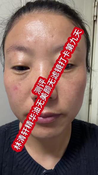 今天是我林清轩精华油无滤镜无美颜打卡第九天#测评 #无美颜无滤镜 #好饭直接点手势舞