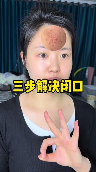 三步解决闭口#闭口 #痘痘 #原相机