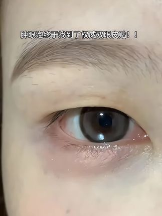 #单眼皮 #内双 #肿眼泡#双眼皮贴