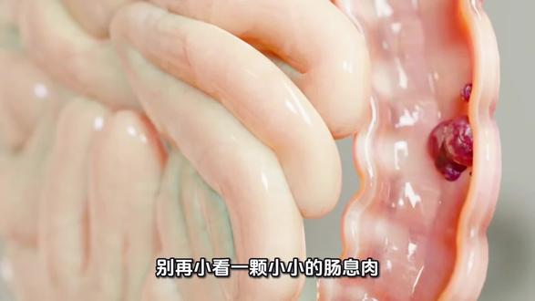 肠息肉不可怕,类器官精准诊疗更安心✨
#肠道健康 #肠息肉 #肠癌早筛 #类器官 #精准医疗