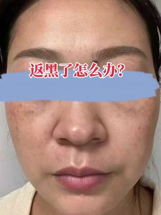 #做斑反黑 返黑了怎么办,能干净吗?
