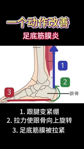 一个动作改善足底筋膜炎#足跟骨刺 #足底筋膜炎 #脚酸 #南昌运动康复