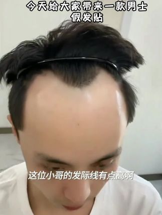 男发际线假发贴男士前额发际线真发贴片隐形M型发际线后移生物皮#赵敏的扮演者照片 #男士造型 #男发型 #男士理发店
