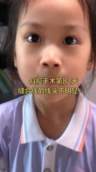斜视手术恢复效果 回复 @🌈Miles的评论 天津眼科医院全国十大技术权威之一,所以来的肯定已经在当地确定才来的,我家第82天,好多老铁说有线头,我家看着不清楚。#真实生活分享计划 #抖音二创激励计划 #抖音健康使用计划 #记录真实生活 #斜视手术恢复中