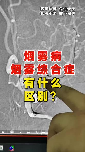 烟雾病 烟雾综合症有什么区别? #烟雾病 #烟雾综合症 #医学科普 #抖出健康知识宝藏 #健康科普破圈计划