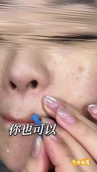 经常爱长痘粉刺脂肪粒的姐妹 这个小东西真的太好用了,戳上不疼还不留印,一次一抛干净又卫生!!,#一次性粉刺针 #亲测好用 #一次性碘伏棉签棒 #消毒棉签 #痘痘黑头粉刺拜拜