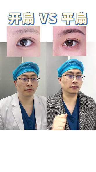 #李瑞双眼皮 平扇VS开扇看看区别到底在哪里! #手术室日常 #合肥双眼皮 #双眼皮种类 #抖出健康知识宝藏