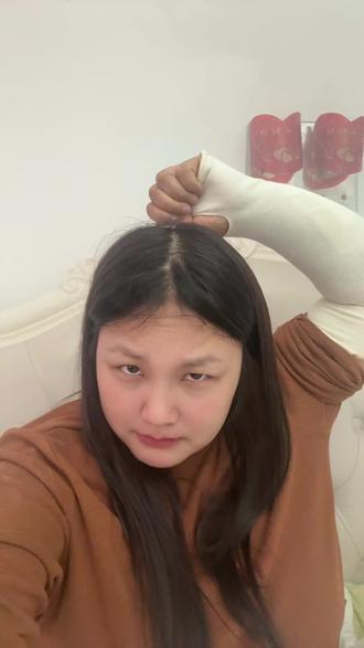 右臂尺骨桡骨双骨折19天,术后16天,忍痛康复中!加油!