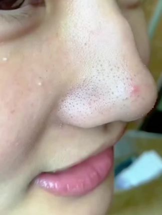 #皮肤问题 #护肤 #清洁毛孔 #去黑头鼻贴 #去黑头面膜膏