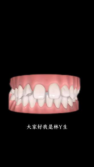 门牙外凸! 那我们这次操作如何让门牙内收呢…#牙齿正畸 #整牙历程 #牙齿正畸经历分享 #厦门 #厦门口腔医院