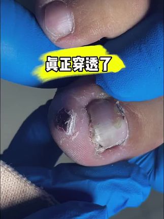 严重的甲沟炎#强迫症 #手艺人在抖音 #修脚大师