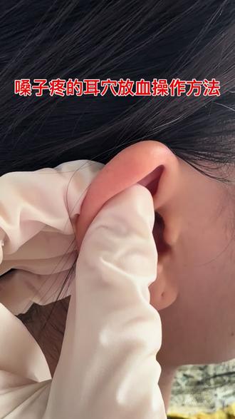 嗓子疼,可以在耳尖和扁桃体炎穴位放血,疼痛感缓解#耳穴 #耳穴放血