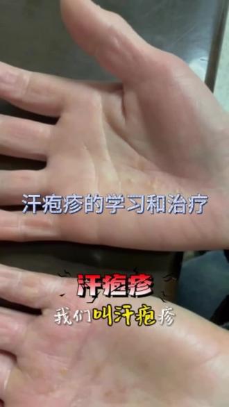 手掌的疱疹要注意了#医疗知识小科普 #医学科普健康 #医学冷知识