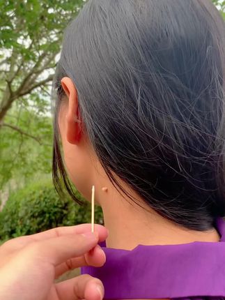 #脖子上的小肉粒 #变美就是这么简单