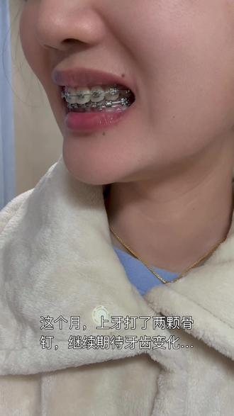 深覆合正畸,戴钢牙套的两年变化 #牙齿正畸经历分享 #深覆合#深覆合#苏州整牙