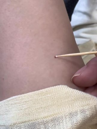 哪里有点哪里 #脖子上的小肉粒 #脖子上的小啾啾 #疣 #疣体祛除