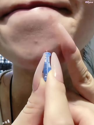 这个一次性的,可比大头针好用太多了!关键还便宜!老爱手欠挤包包的,就用这种比头发丝还细的次抛,干净卫生还方便#女生必备#痘痘肌#清洁工具#我捡到宝了 #种草
