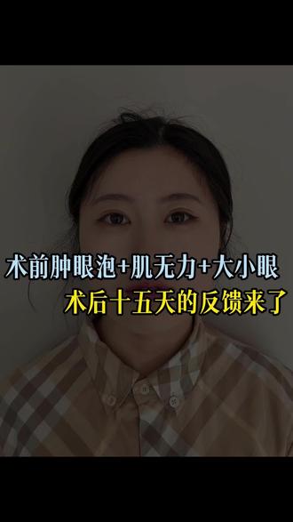 双眼皮15天的状态#双眼皮 #双眼皮手术