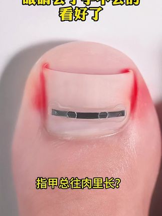 #脚指甲往肉里长怎么办 #嵌甲修理 #嵌甲矫正 #嵌甲修复 #嵌甲