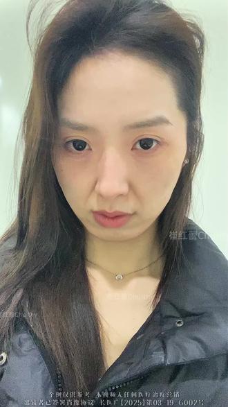 打薄提升一个月~
#打薄#馒化#面部提升#双韧焕颜提升#对比