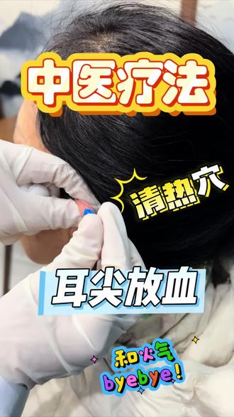 🌿 一针耳尖血,泄掉一身“火气”!#耳尖放血 #清热去火 #明目 #鞍山小倪 #鞍山市中医院