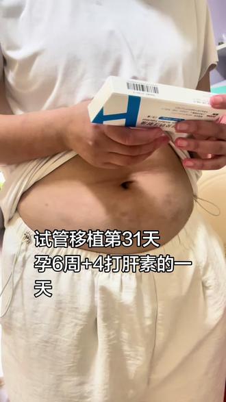试管移植第31天,孕6+4有胎心胎芽没有孕反,孕6+1二超胎芽6mm,有卵巢刺激综合征加上hcg26600多,大白说翻倍有点慢,需要继续打肝素,到7周的时候再返院验孕三项和B超,感觉我的大白很有责任心每一步都为我考虑到位#真实生活分享计划 #我的孕期日记 #创作者扶持计划 #热点小助手#二代试管