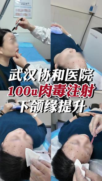 武汉协和瘦脸➕下颌缘提升 #肉毒素 #武汉协和罗超#瘦脸#下颌缘提升 #咬肌 #除皱针