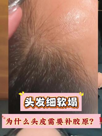细软塌必看!补胶原才是救命路
头发软、塌、贴头皮
真不是发质问题
是头皮松、没支撑力
头皮就像头发的土壤
土壤松垮,发根站不住
补头皮胶原=给头皮打地基
头皮紧致健康,发根才稳
发根稳了 → 头发自然蓬松挺立
不用烫不用夹,氛围感轻松拿捏✨
#头皮胶原 #细软塌救星 #养头皮 #发根蓬松 #护发干货