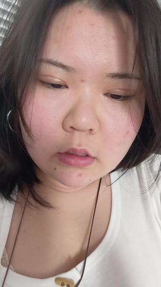 总的来说,左眼比右眼做的要好看一点 右眼的眼头没收进去,然后眼尾有猫耳朵,但是为了这一点小问题去专门再挨一个刀,因为好像没有那个必要现在就是等他什么时候能轻薄一点#双眼皮日常 #双眼皮恢复记录 #双眼皮蜕变记
